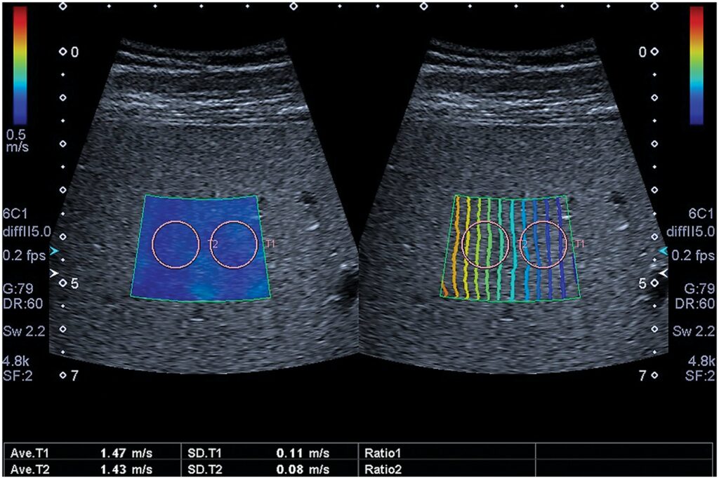 Rumāņu nacionālās aknu elastogrāfijas vadlīnijas un praktiskie ieteikumi