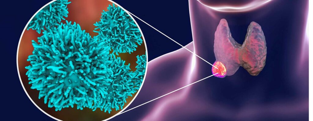 Rekomendācijas vairogdziedzera mezglu punkcijas biopsijai.